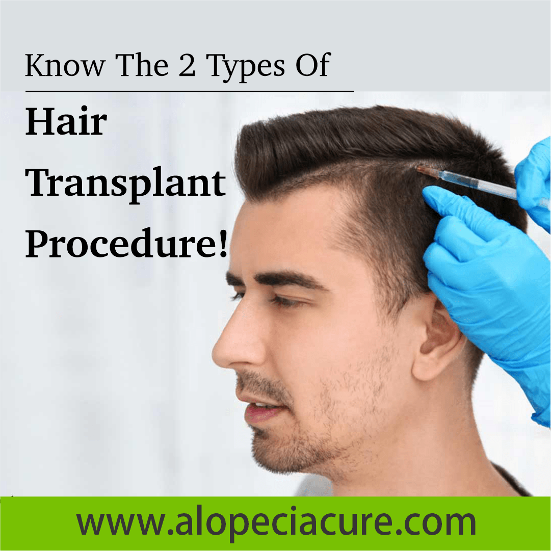 hair transplant